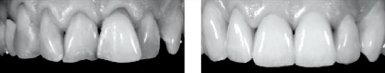 The aesthetic correction of upper incisors and canine teeth