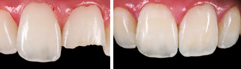 natural reconstruction of an incisor broken through