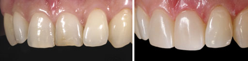 Correctly aligning teeth